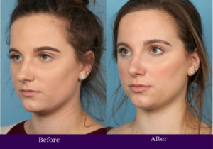 How a Nose Job Can Improve Your Facial Harmony