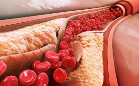 How a Physician Treats High Cholesterol