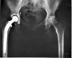 Understanding Types of Hip Replacement Techniques