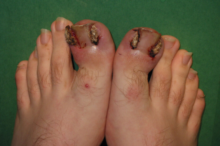 Signs You May Have Toe Nail Fungus and What To Do